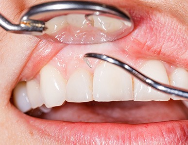 Closeup of someone’s teeth being cleaned by a scaler with a dental mirror pushing lip back