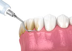 Rendering of a ¾ profile view of plaque being scraped away by a scaler