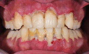 Patient's mouth with advanced gum disease